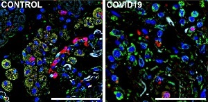 Imágenes de tejidos pulmonares obtenidos en autopsias, tomadas mediante inmunofluorescencia: a la derecha, de un paciente fallecido debido a complicaciones ocasionadas por el COVID-19, y a la izquierda, de uno con muerte por una causa no relacionada. El color azul representa al núcleo de las células, el verde a un marcador (S1009) de monocitos y macrófagos infiltrados en el tejido, y el rojo al receptor CD36. Los macrófagos y los monocitos que expresan tanto S1009 y CD36 aparecen en amarillo por superposición de ambos (imagen: Alexandre Fabro y Edismauro Freitas-Filho)