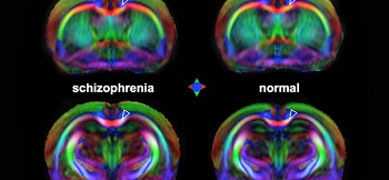 Esquizofrenia-Resonancia Magnética Funcional