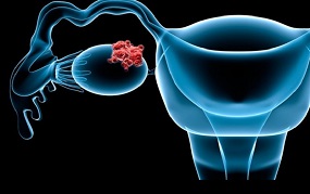 Cáncer de ovario. Fuente: La Verdad Noticias.com