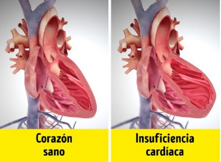 Insuficiencia cardíaca. Fuente: AloDoctor