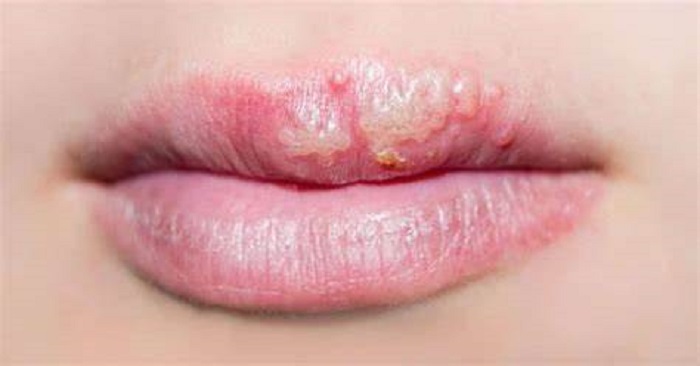 Herpes genital. Fuente: Souenfermagem