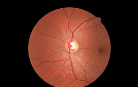 Glaucoma. Fuente: IMMedico