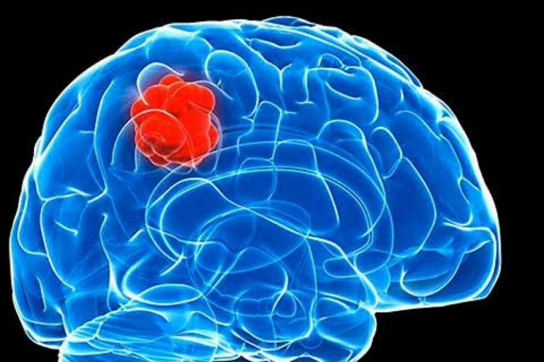 Glioblastoma. Fuente: FDAhealthnews