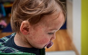 OPS. Alerta sarampión