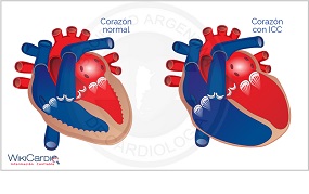 Insuficiencia cardiaca