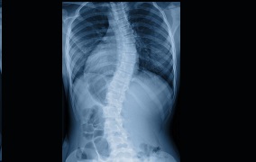 Escoliosis