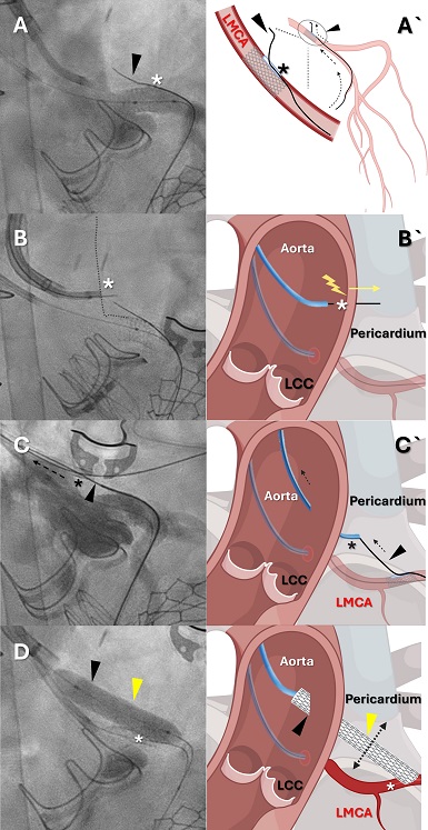 Bypass coronario mínimamente invasivo