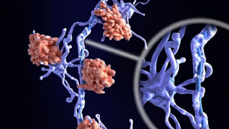 Esclerosis múltiple