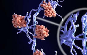 Esclerosis múltiple