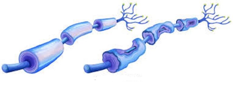 Neuropatía periférica