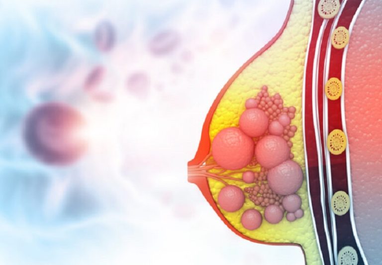 Cáncer de mama