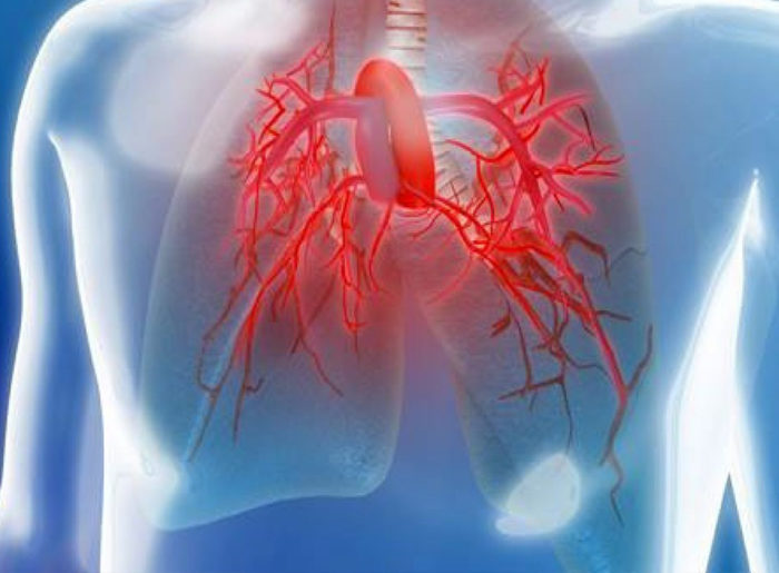 Hipertensión pulmonar