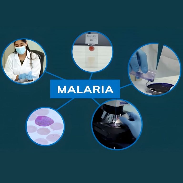 Malaria