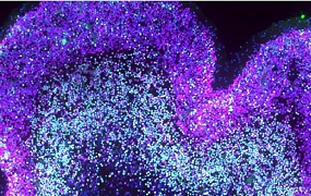 Neocortex en el síndrome de Down